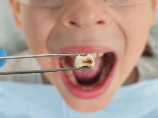 Best Emergency Wisdom Teeth Removal in Somerville, TX